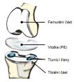 Celková sestava kloubního implantátu. Foto: archiv ÚST FSI